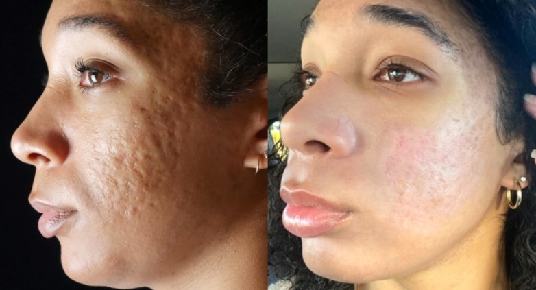 How to naturally heal acne scars