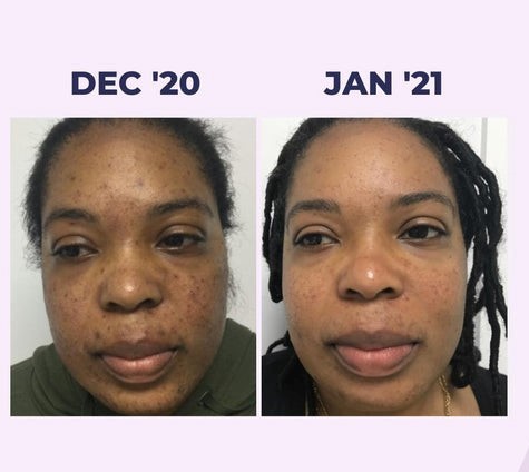 Hyperpigmentation treatment for black skin