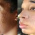 Hyperpigmentation treatment for black skin